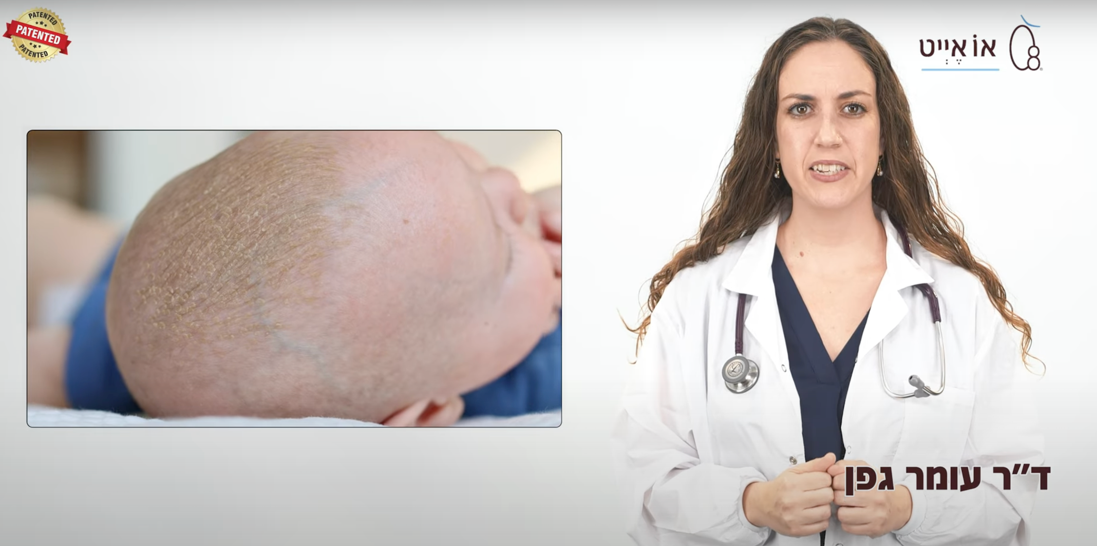 קשקשת - סבוריאה דרמטיטיס - קשקשת בקרקפת ובפנים אצל תינוקות מאת ד״ר עומר גפן וד״ר אור גפן